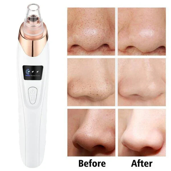 5-in-1 Rechargeable Blackhead Remover