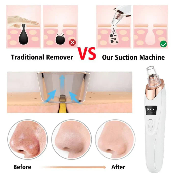 5-in-1 Rechargeable Blackhead Remover